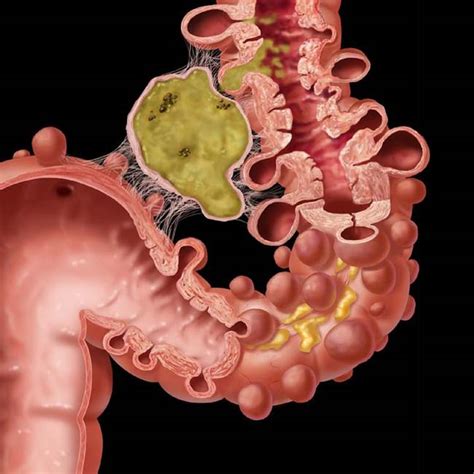 diverticulitis icd 10|diverticulitis with fistula icd 10.